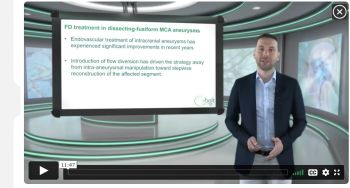 ĐIỀU TRỊ PHÌNH FUSIFORM BÓC TÁCH ĐOẠN MCA BẰNG STENT CHUYỂN HƯỚNG DÒNG CHẢY SILK+/SILK VISTA.