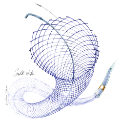 Silk Vista - Stent điều chỉnh dòng chảy